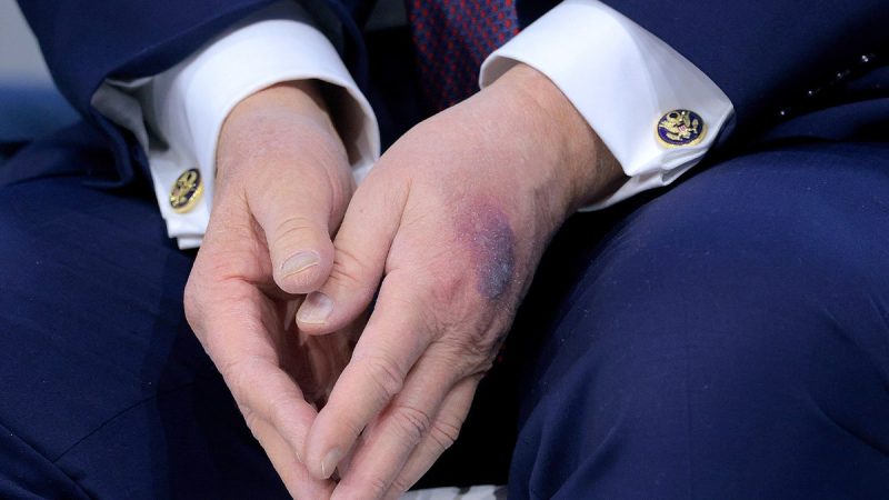 White House explains bruise on Trump’s hand White House explains bruise on Trump’s hand